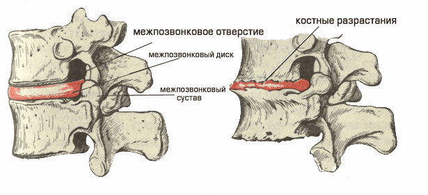Деформация позвонков по причине остеохондроза