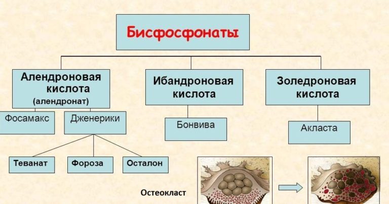 Лечение остеопороза бисфосфонатами