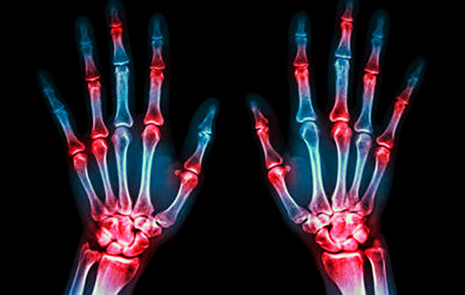 Лекарства и рецепты от болей в суставах