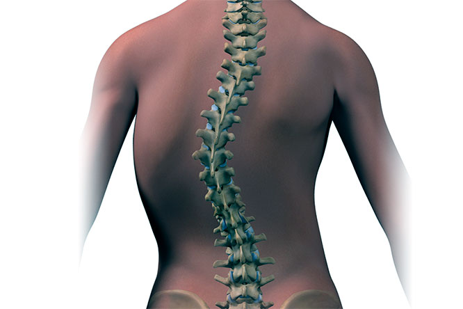 Левосторонний сколиоз