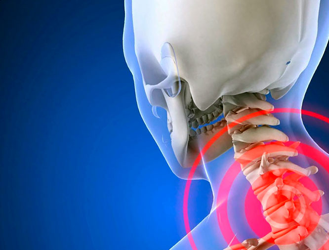 Остеохондроз шейного отдела