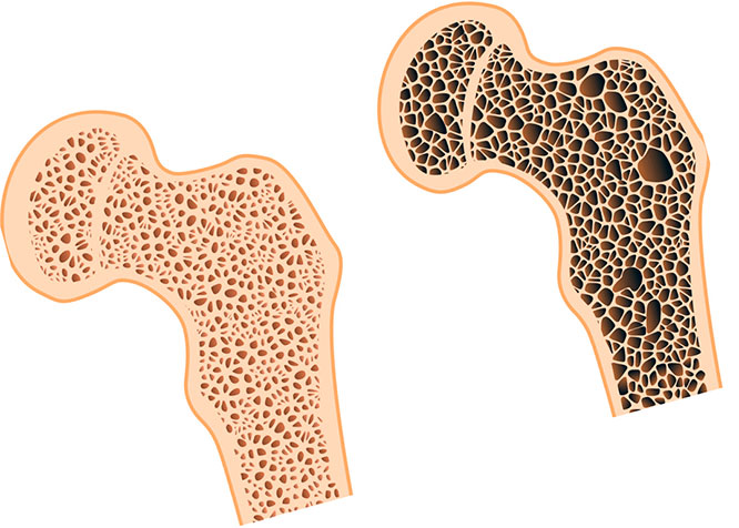 Остеопороз