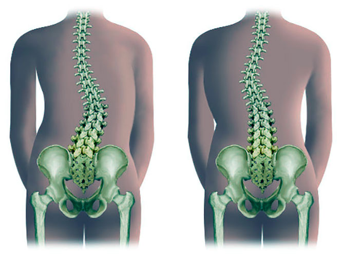 Сколиоз поясничного одела