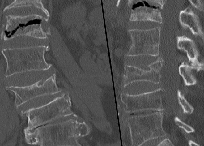 болезнь Кюммеля на рентгене