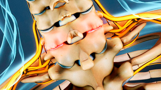 остеофиты в шейном отделе позвоночника
