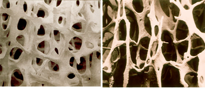 остеопороз: симптомы и лечение
