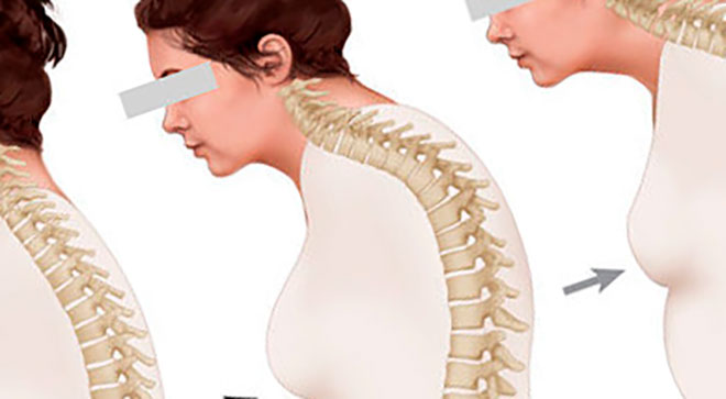 у женщины сенильный кифоз