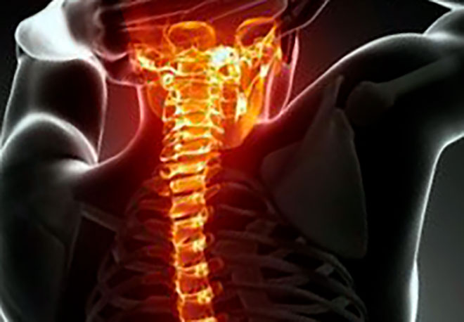 остеохондроз