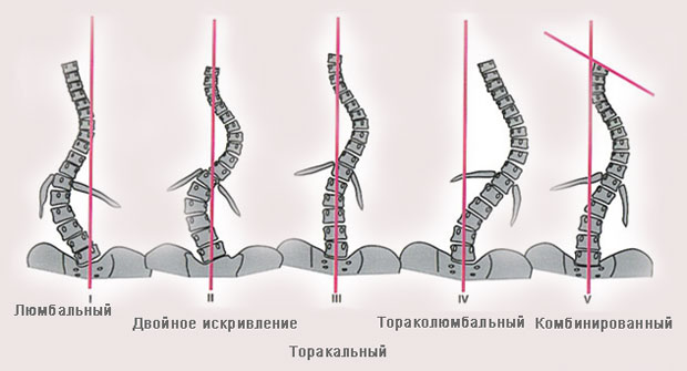 Формы сколиоза Формы сколиоза