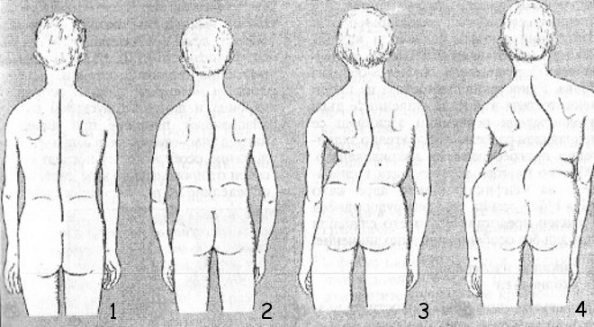 Степени искривления позвоночника при сколиозе Степени искривления позвоночника при сколиозе