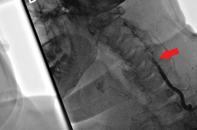 мрт снимок вертебрально-базилярной недостаточности при шейном остеохондрозе