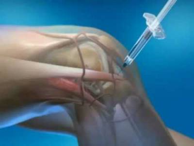 Укол в колено Укол в колено