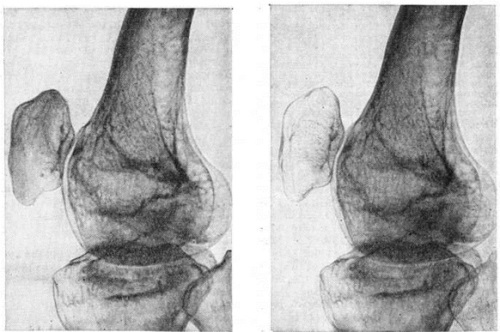 Zudeka Рентгенограмма колена, слева - до развития заболевания, справа - остеопороз надколенника