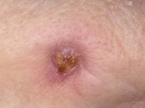 aktinomik2 aktinomik2