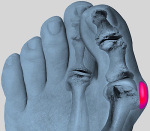 artroz-bpn3 artroz-bpn3