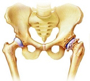 deform-osteoar deform-osteoar