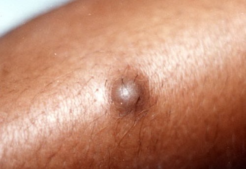 dermatofib2 dermatofib2