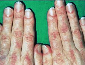 dermatomioz dermatomioz