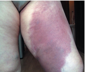 dermatomioz2 dermatomioz2