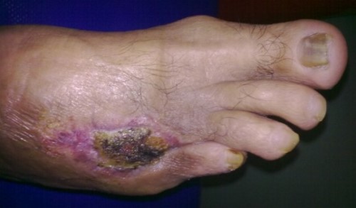 diab-gang2 diab-gang2