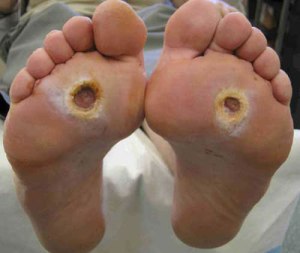 diabet-stopa diabet-stopa