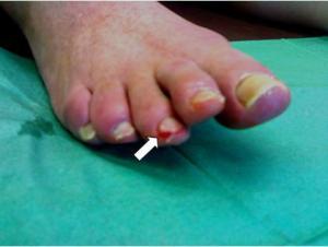 diabet-stopa3 diabet-stopa3