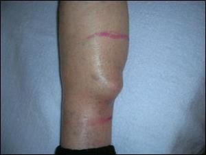 fibros-mt2 fibros-mt2