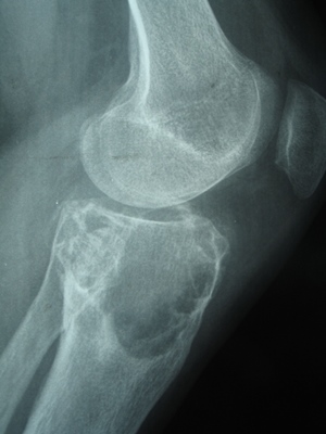 fibrosark2 fibrosark2