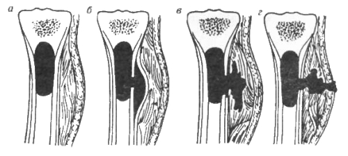 gemat-osteom gemat-osteom