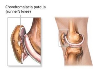 hondromal1 hondromal1