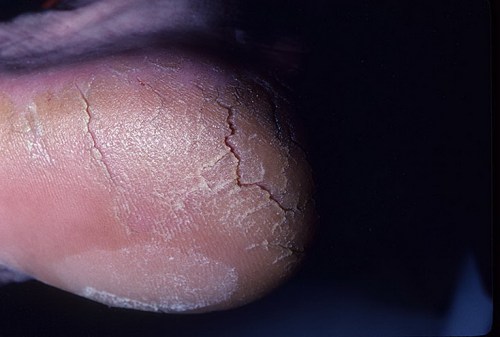 keratoderm keratoderm