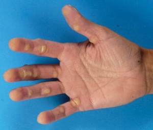 keratoderm2 keratoderm2