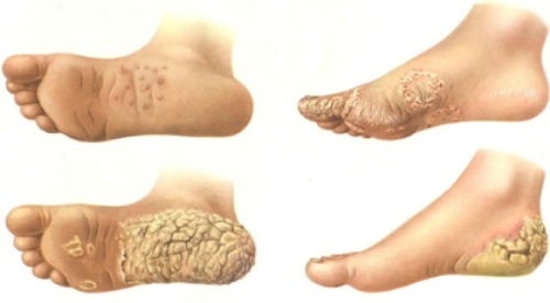 keratoderm3 keratoderm3