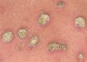 kollagenoz kollagenoz