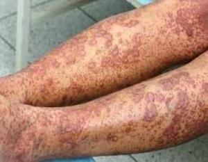 kollagenoz2 kollagenoz2