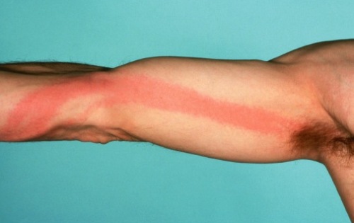 limfangit2 limfangit2