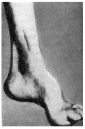 nevrop-mb Невропатия малоберцового нерва