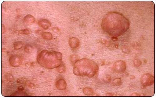 neyrofibromatoz neyrofibromatoz