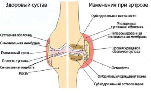 normalosteoarthritis0