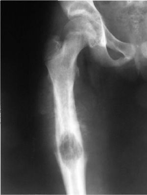 osteogen-sark2 osteogen-sark2
