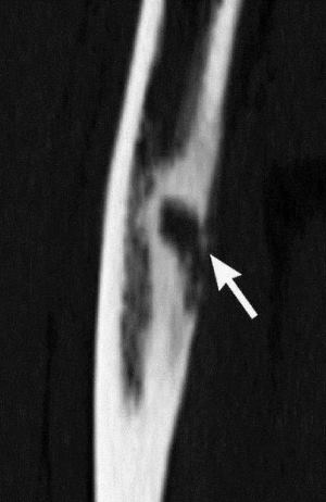 osteom-bedr osteom-bedr