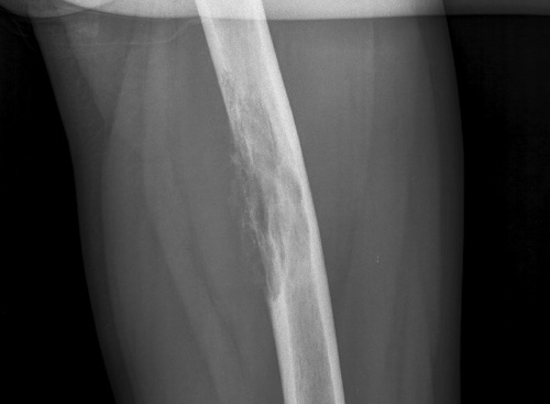 osteom-bedr2 osteom-bedr2