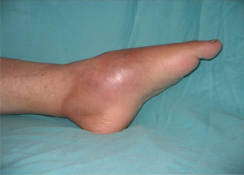 osteom-stop osteom-stop