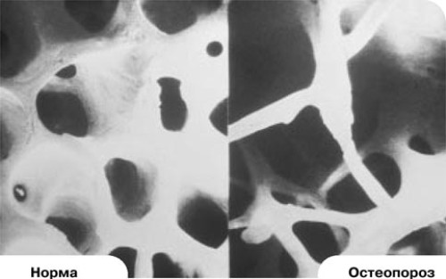 osteoporoz osteoporoz