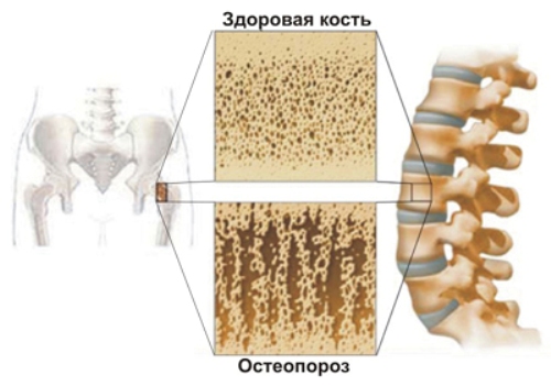 osteoporoz2 osteoporoz2