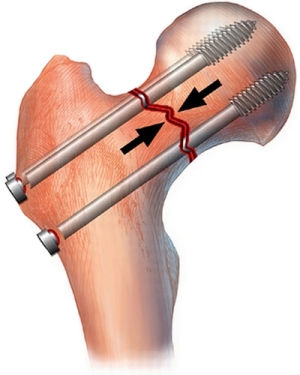 osteosin Остеосинтез при переломе шейки бедра