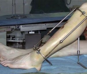 osteosin3 Закрытый интрамедуллярный остеосинтез