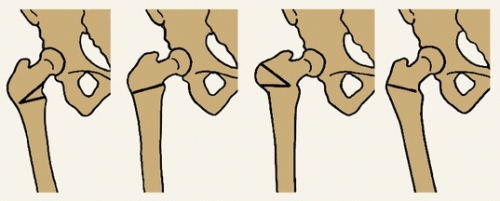 osteotomia2 osteotomia2
