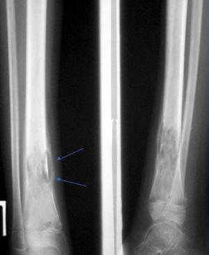 periostit2 periostit2