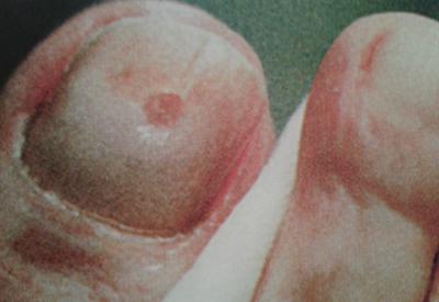 podnog-mozol podnog-mozol